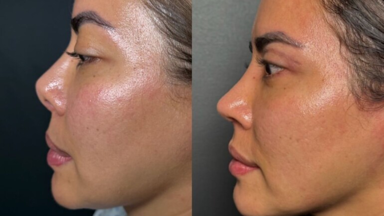 Rinoplastia de alta gama: El cartílago costal de donante como la nueva revolución en cirugía estética