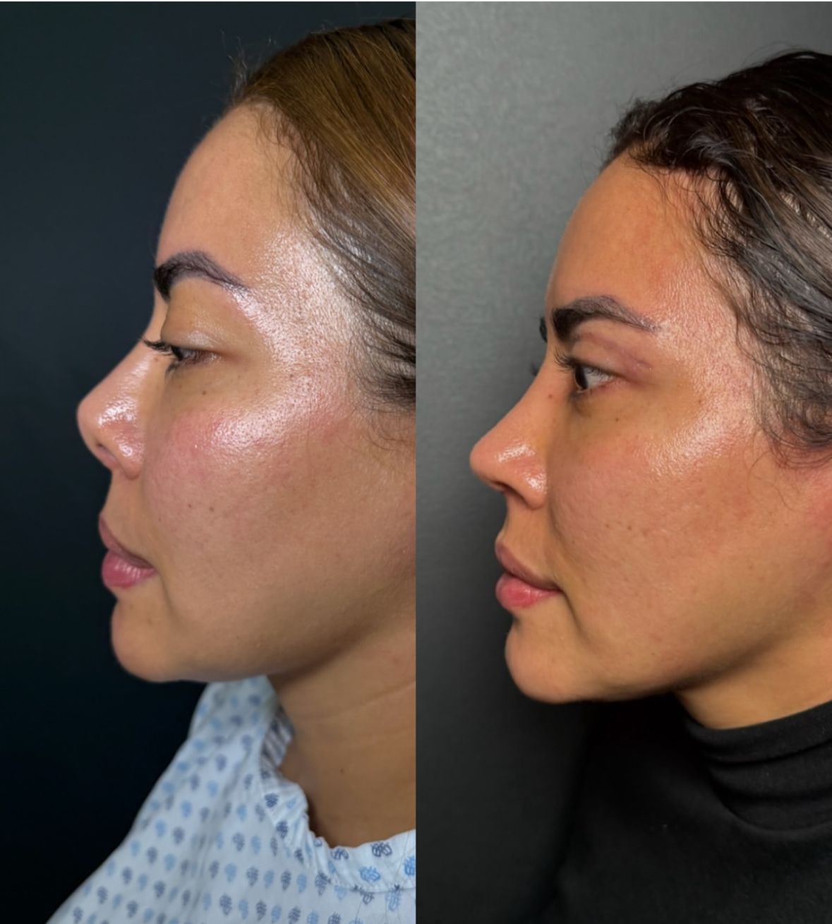 Rinoplastia de alta gama: El cartílago costal de donante como la nueva revolución en cirugía estética